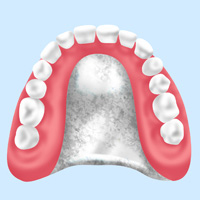 【保険入れ歯】