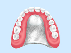 金属床義歯