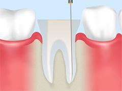 根管治療とは