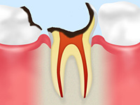 C4歯根の虫歯