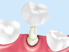 詰め物・被せ物について