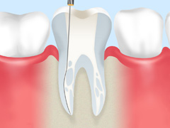 根っこの治療が必要な場合