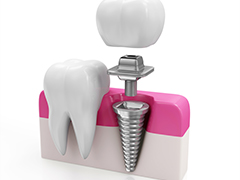インプラント治療とは