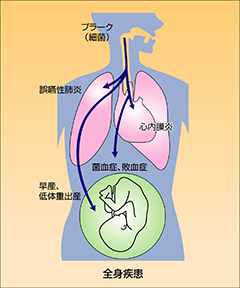 歯周病と全身疾患の関係