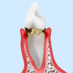 【軽度歯周病】歯周炎